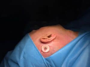 Balıkesir Üniversitesi Hastanesi’nde BAHA Ameliyatı ile İşitme Kaybı Tedavisine Modern Yaklaşım